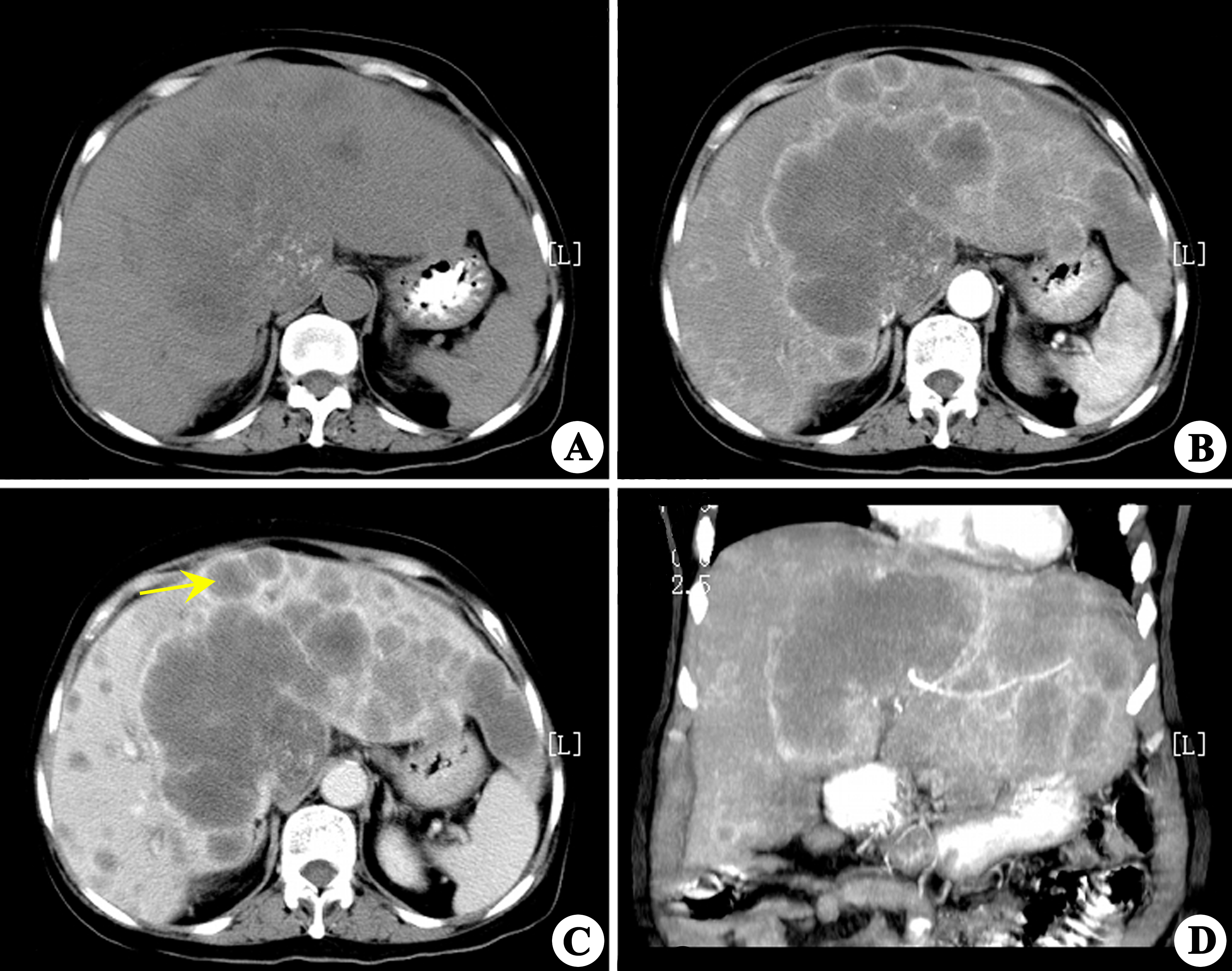 结直肠癌肝转移后5类情况下的具体治疗策略