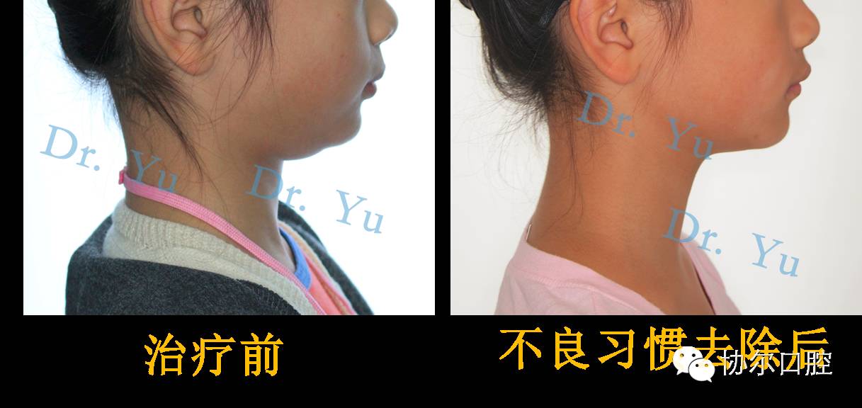 对于不良习惯引起的肌肉功能异常所导致的颜面,牙齿发育异常,针对性地
