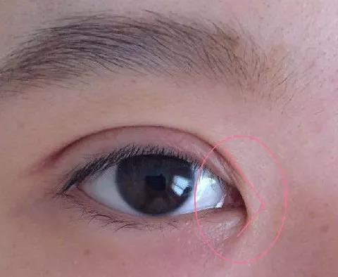 什么情况下需要开眼角内眦赘皮是啥