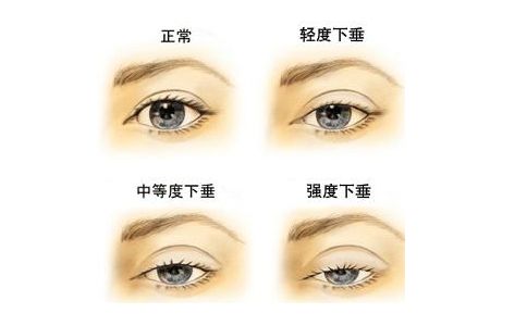 散瞳前后对比,散瞳前和散瞳后的图片,散瞳前后_大山谷图库