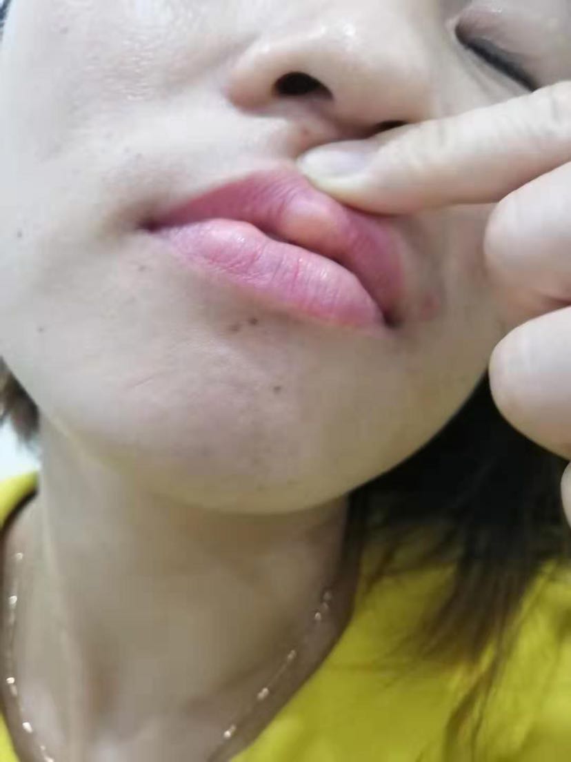 奥美定注射后需要取出来么?