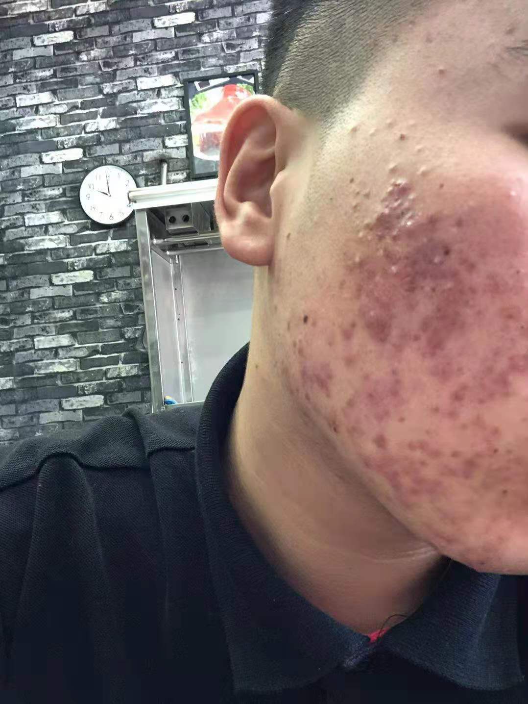 21岁男孩囊肿型痤疮,中药14天后,痘痘明显好转!