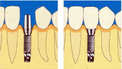 就目前医疗技术而言,做根管治疗后桩冠修复可以很好地保存残冠残根,根