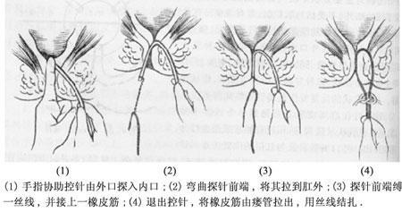 直肠里的内口并没有愈合,又会在身体的另外部位形成一个窦道,从而出现