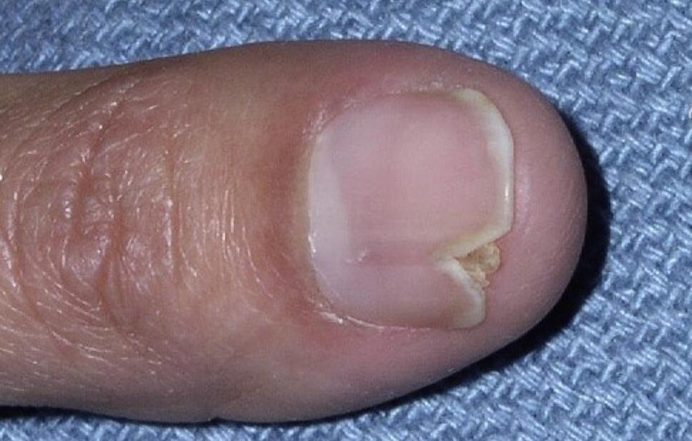 指甲甲乳头瘤图片