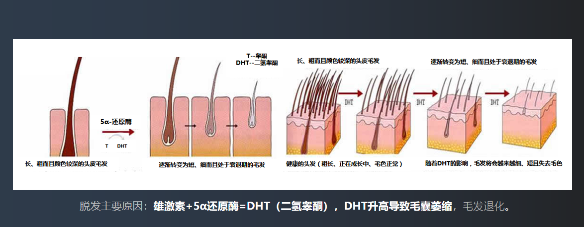 雄激素性脱发原理图片