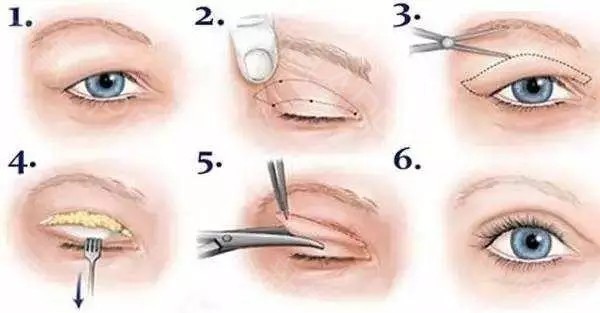 眼部抽脂的过程图图片