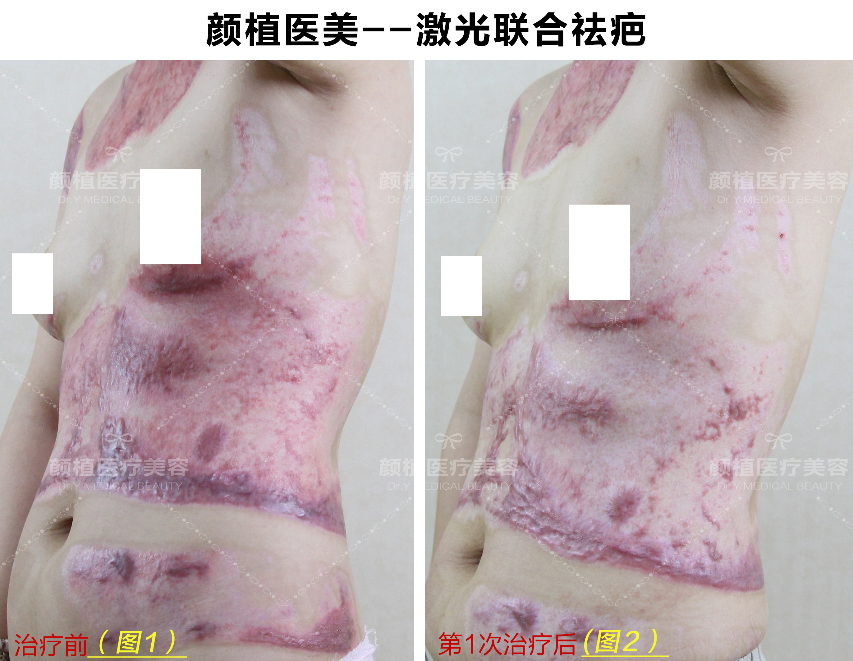 烫伤(图1),老公带其四处求医,都说除了手术植皮没有其他办法治疗皮肤
