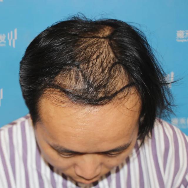 手冲会脱发?中国超1.3亿男人现在都慌了!(附带秃顶改善)