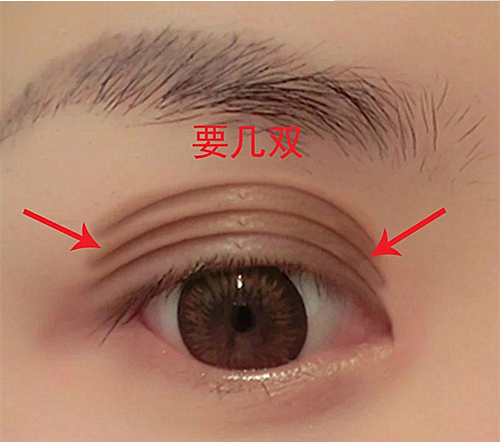 惊!小内双割完双眼皮会变"三眼皮"?医生的神操作?