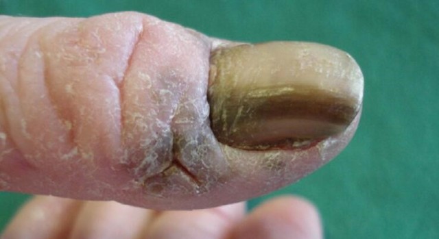 甲母质瘤治疗方法手术切除受累的甲母质拔甲后可见甲母质部绒毛状