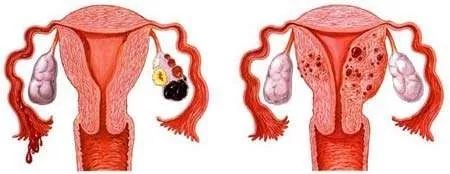 子宫内膜异位症是会哭泣的痛