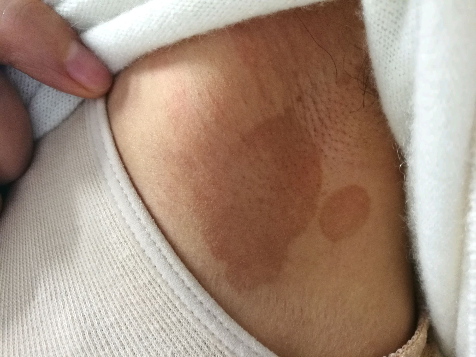 夏季常见的花斑糠疹坚守到冬季