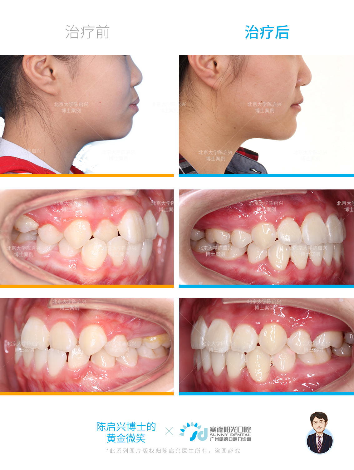 昆明牙齿矫正| 不拔牙矫正案例| 一年半时间深覆合、牙弓狭窄问题改善明显 - 知乎