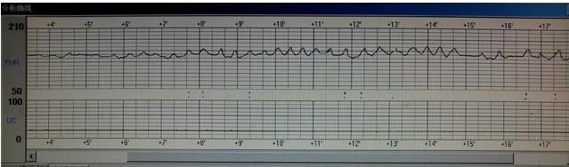 孕晚期发现胎心监护不好怎么应对？