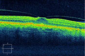 这是炎症影响视网膜表面的结果,形成原因可能是:炎症致玻璃体浓缩