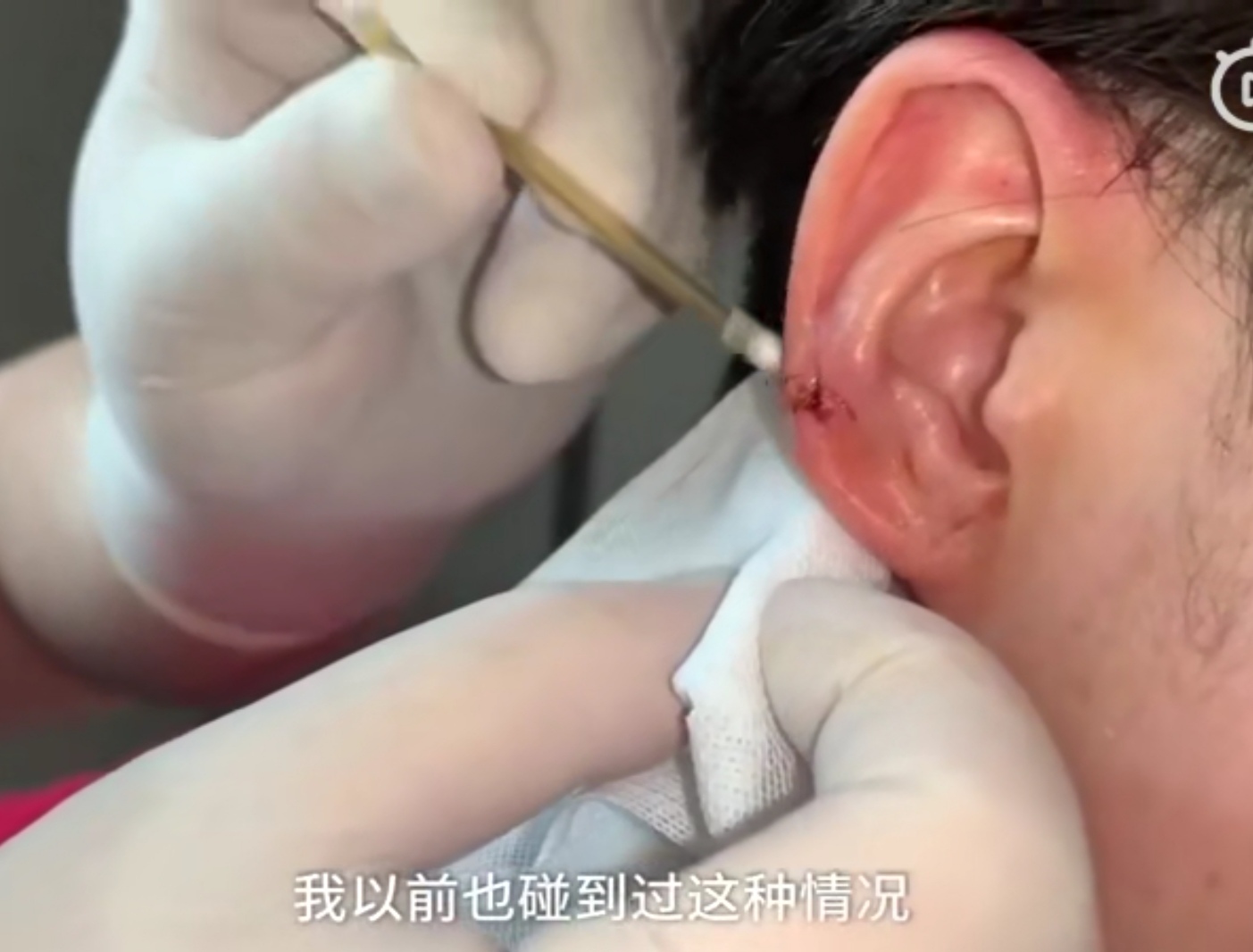 医生用头发丝缝合伤口