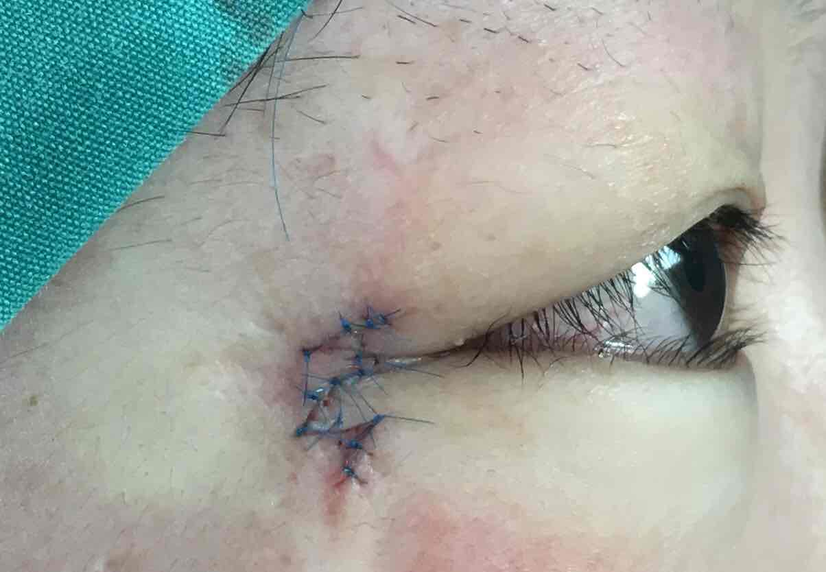 眼角皮瓣手术后修复图图片