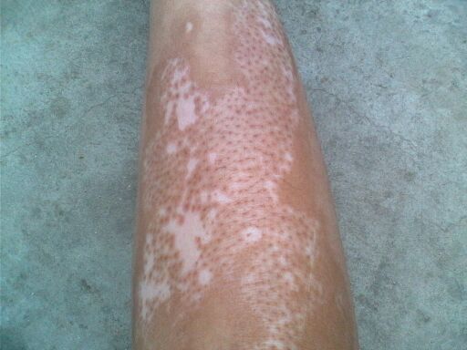 【白癜风药物】盐酸氮芥酊治疗白癜风效果如何