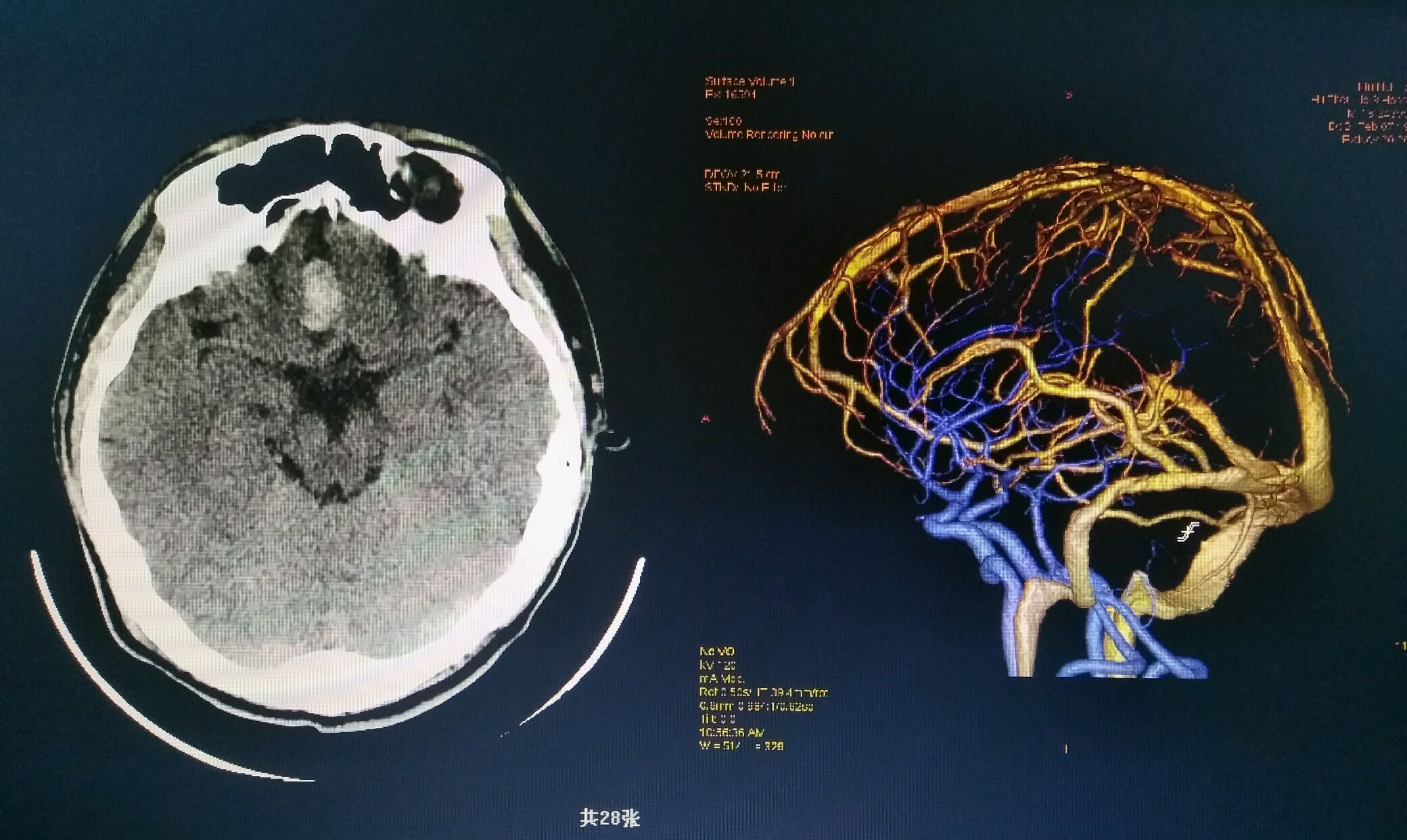 脑出血死亡的重要原因