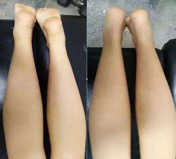 小孩长短腿这是什么病
