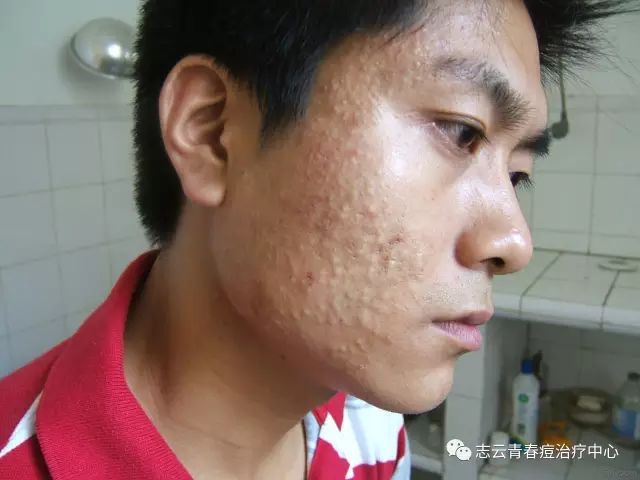 白头粉刺和黑头粉刺有什么不同?