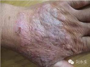 慢性湿疹的位置及表现慢性湿疹好发于四肢,如手足,小腿,肘窝,腘窝等处