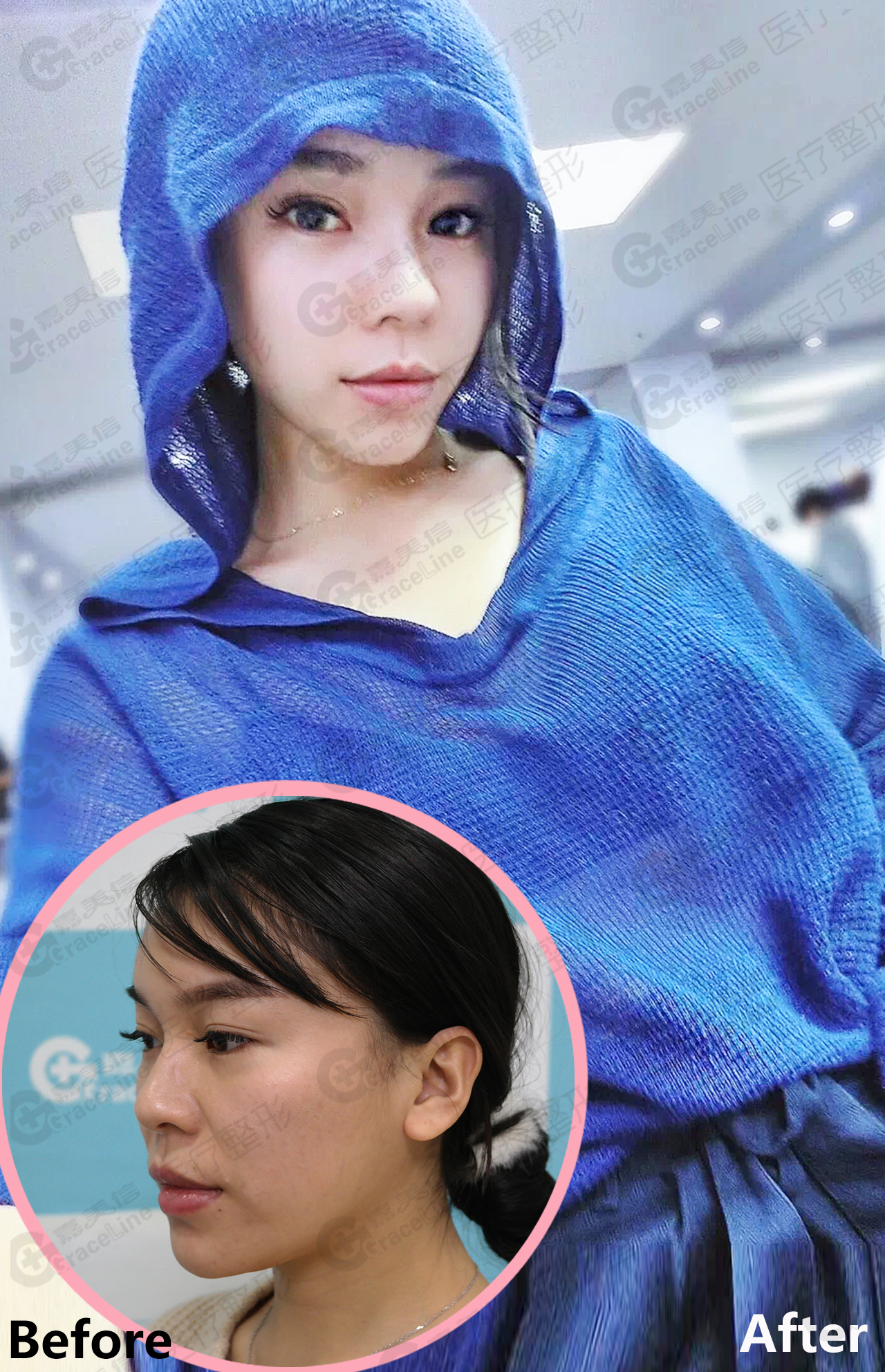 面部填充整形_整形填充面部多久恢复_整形填充面部有风险吗
