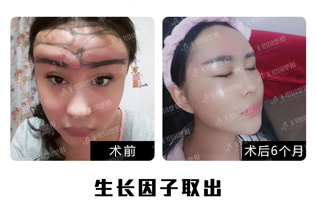 生长因子取不彻底,100%会复发!