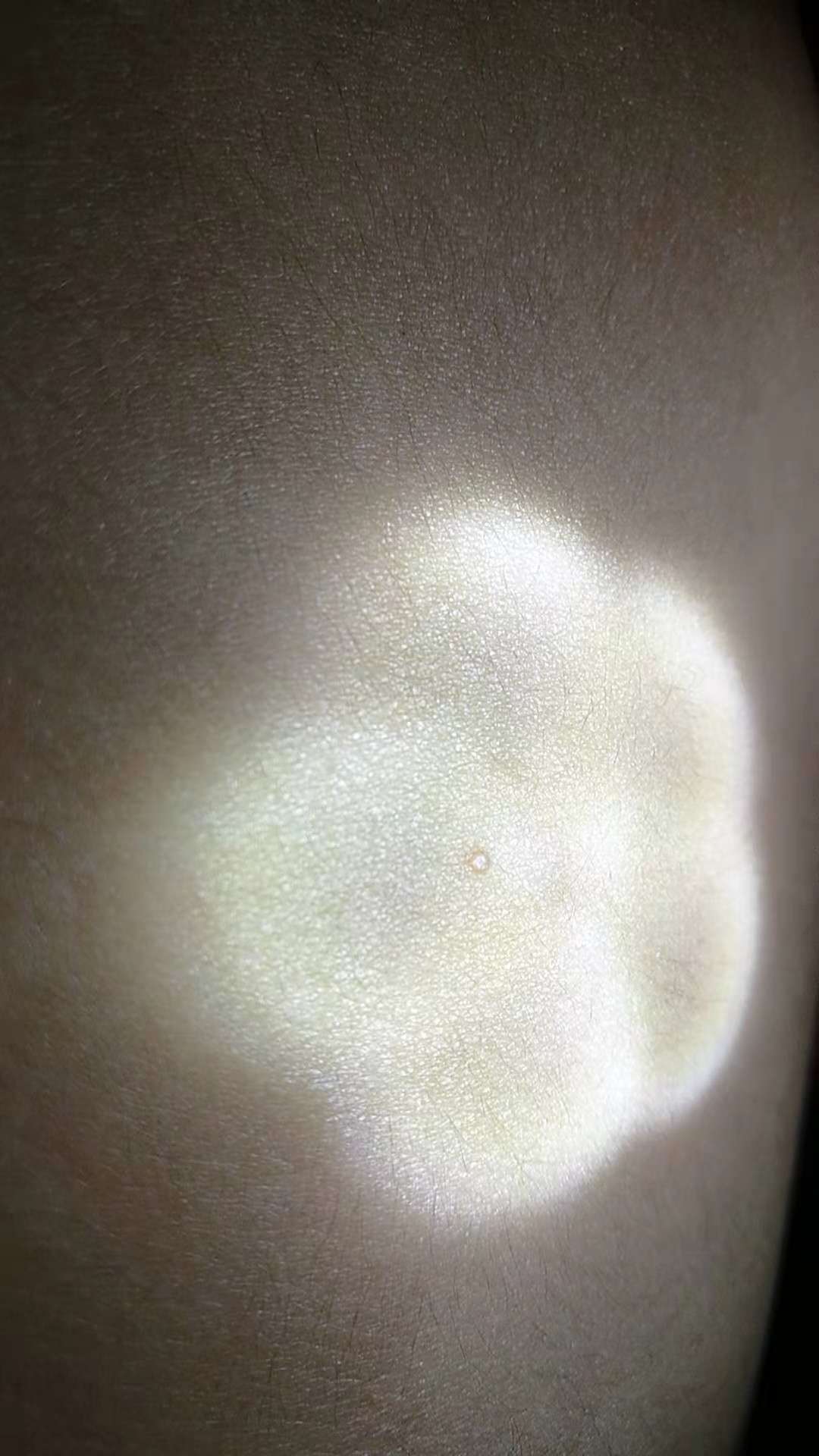 需要说明的是,传染性软疣因为是病毒感染,不治自愈,也是有的.