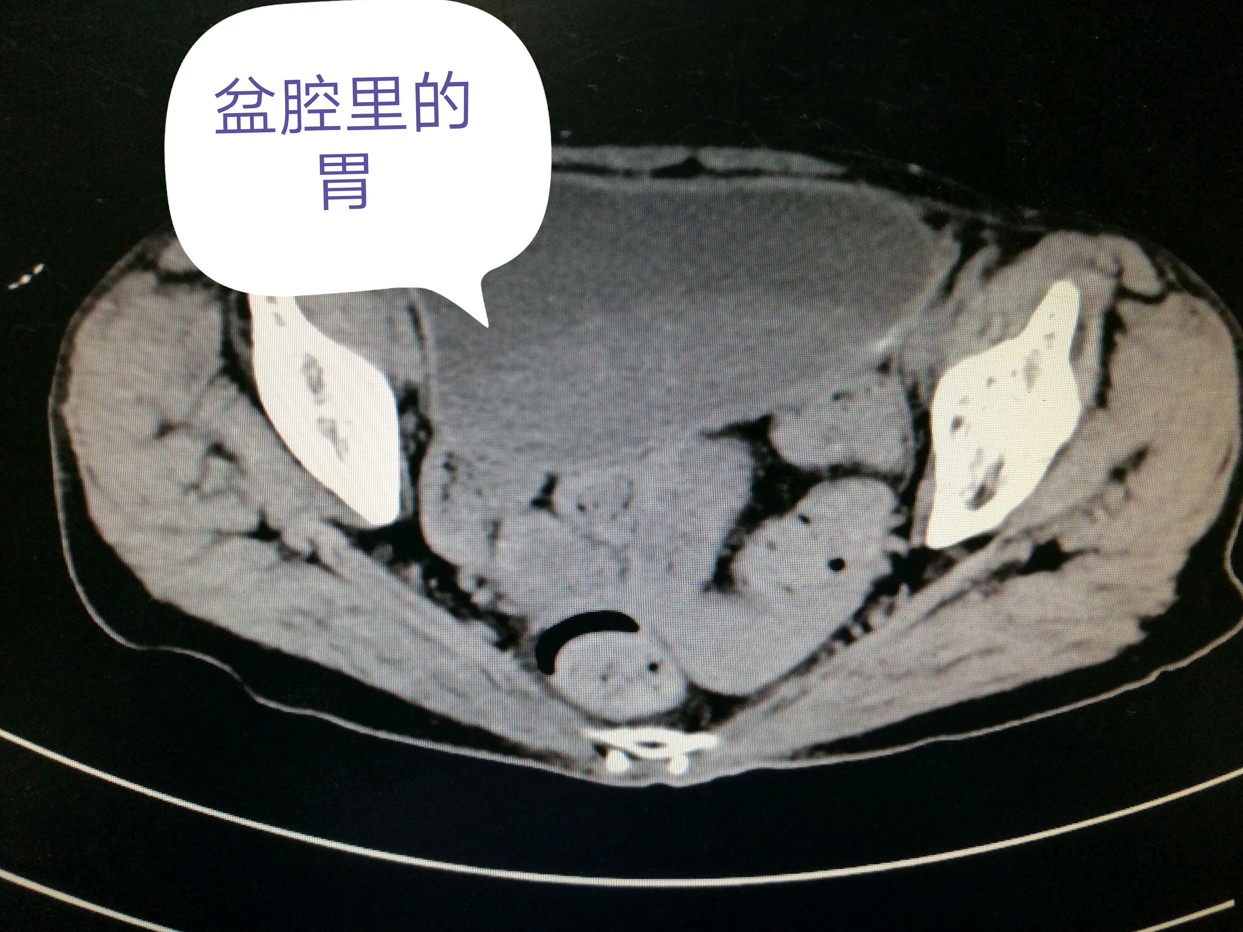 胃潴留-你的胃竟然可以扩张到这么大!