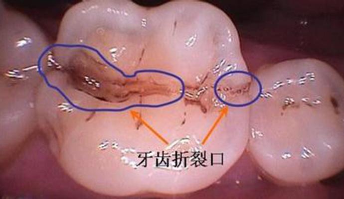 牙齿的最后一道防线,根管治疗是你最后的倔强
