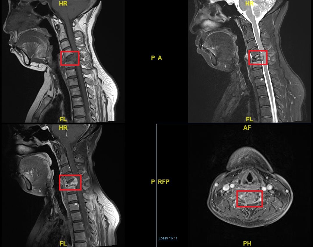 最常见的脊柱肿瘤脊柱转移瘤