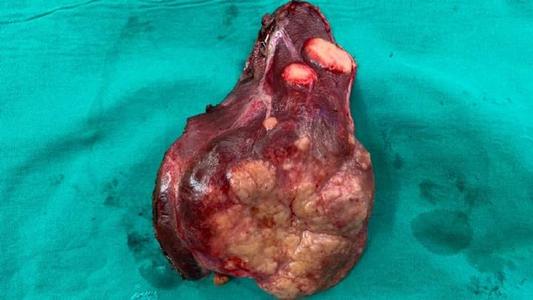 肿瘤转移到肝脏就没救了吗?