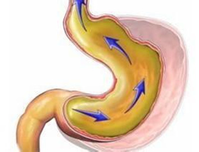 胆汁反流性胃炎 ,为什么久治不愈?治疗的关键点是什么?