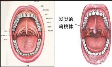 小孩扁桃体化脓反复发作,中医可以保驾护航