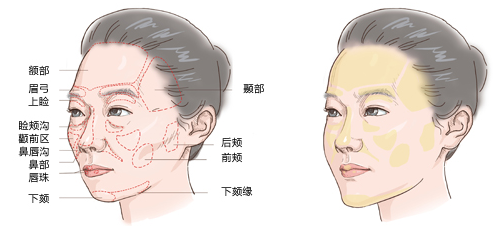 如何改善面部凹陷