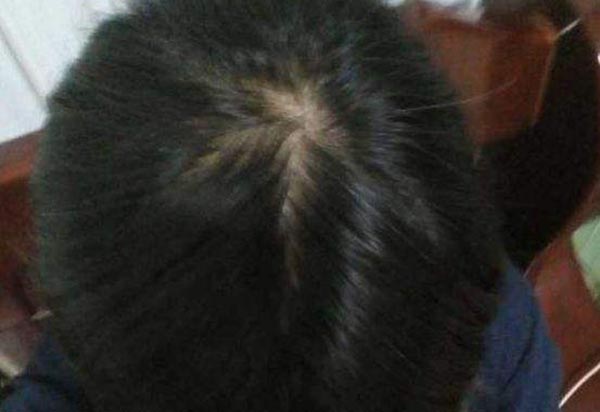 头顶脱发是什么原因 生发的最好方法 李斌住院医师 爱问医生