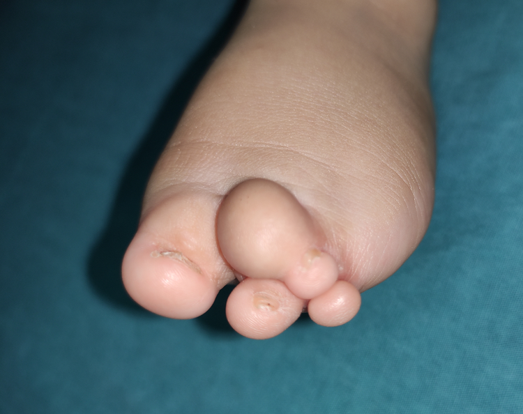婴儿脚趾并指图图片
