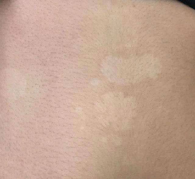 白色皮疹怎么看