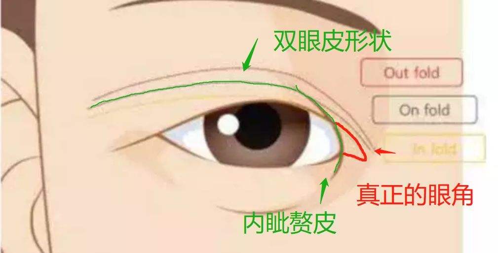 "内眦赘皮"是指在内眦角前方的一片垂直的皮肤皱襞,它遮掩着内眦角