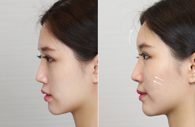 丰苹果肌小知识