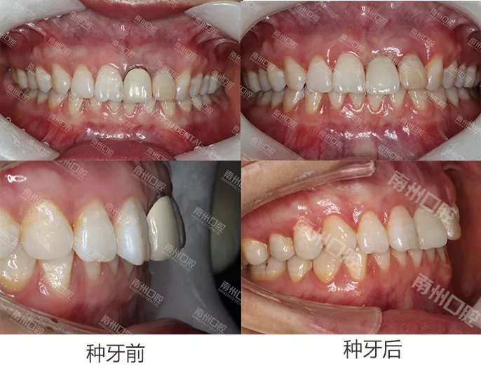 門牙折斷,種植牙修復案例分享