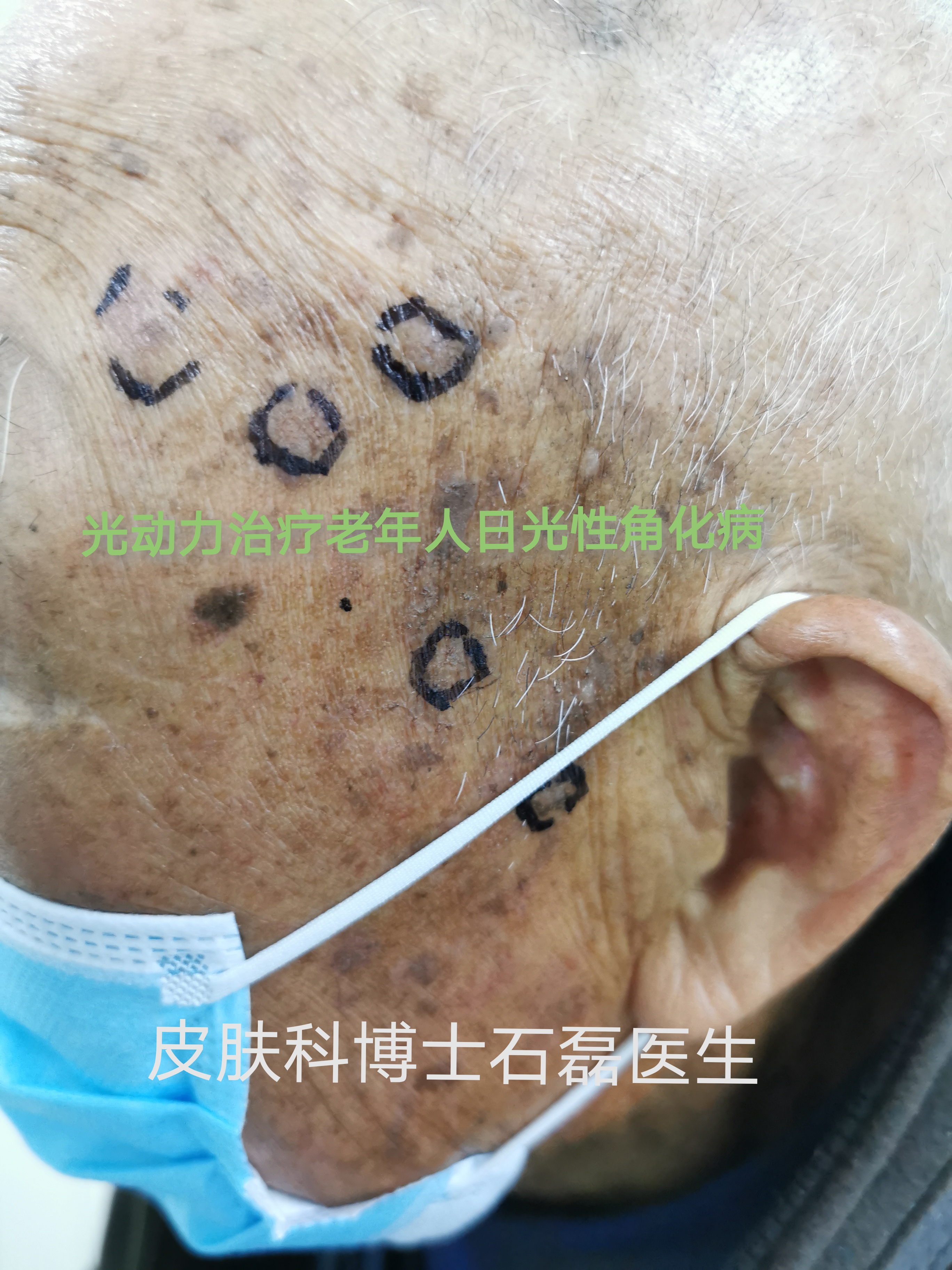 光动力治疗日光性角化病 石磊主治医师 爱问医生