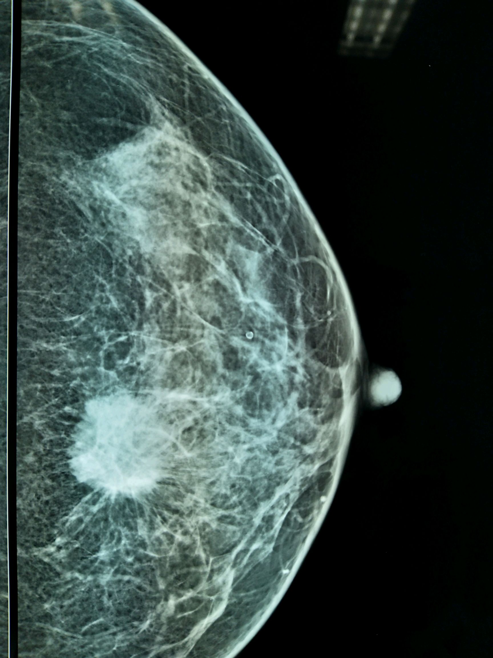 乳癌早期图片