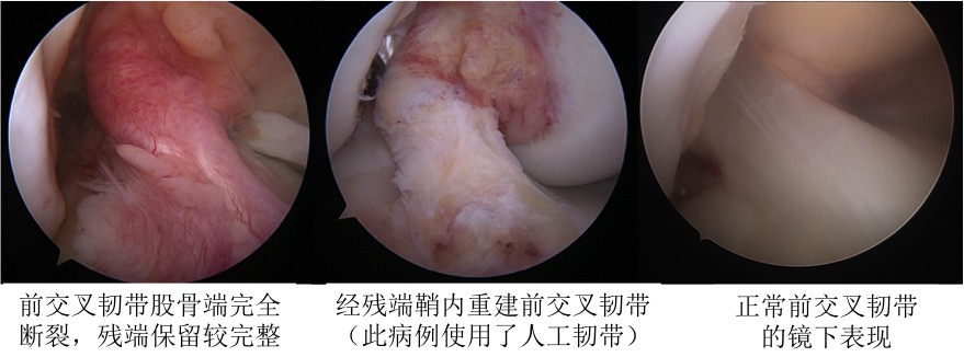 使用的移植物主要包括自体,异体及人工韧带.