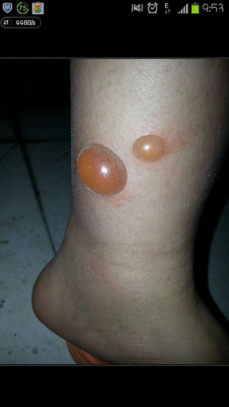 全身突然起红肿水疱 春夏季烧烤出游警惕丘疹性荨麻疹