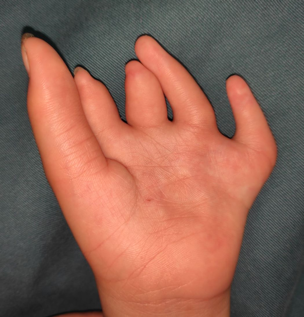 小孩畸形手指图片图片