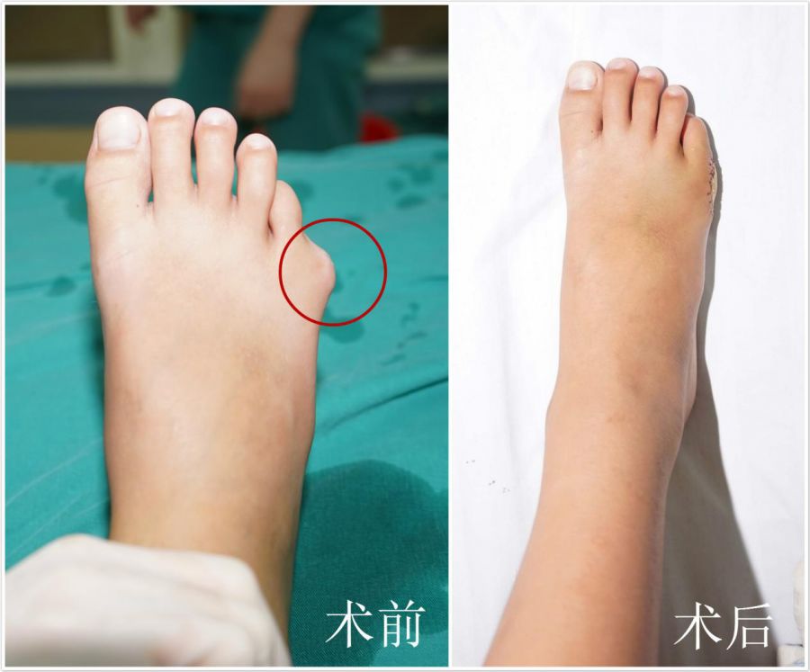 儿童多趾畸形怎么办?手术在1岁以后最佳