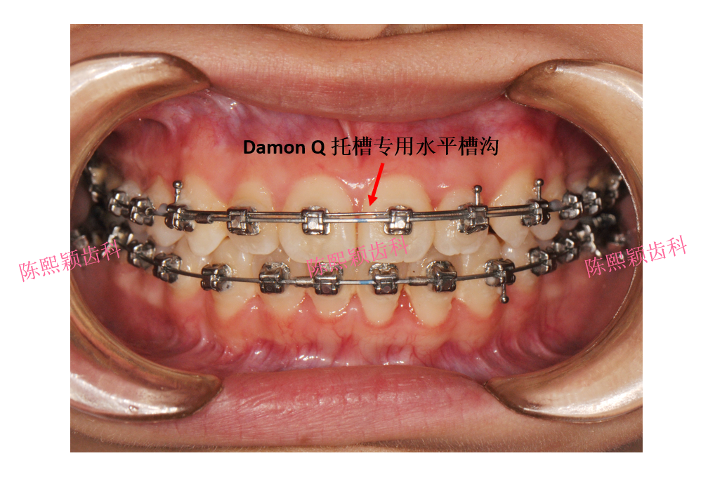 在左侧尖牙区加装几个damon托槽专用的游离牵引钩(放入垂直槽沟),并